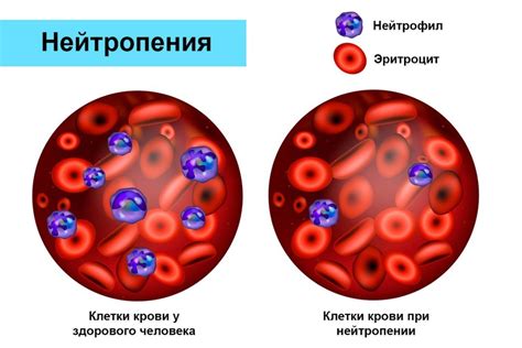 Аутоиммунные заболевания как причина повышенного уровня нейтрофилов