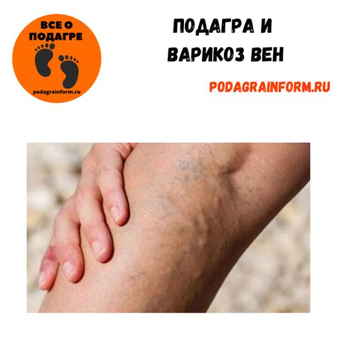 Влияние кофеина на развитие подагры
