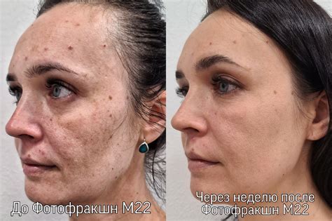 Влияние сеансов засветления в солярии на состояние кожи: достоинства и недостатки