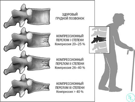Влияние травм и переломов на состояние позвоночника