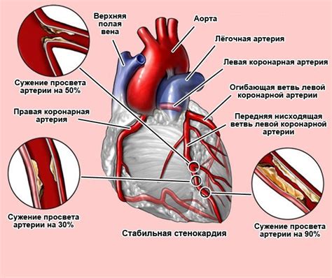 Влияние тренировок на работу сердца при стенокардии