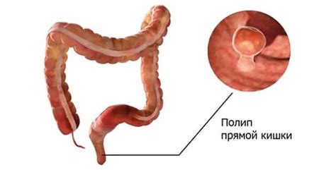 Возможные причины образования уплотнения в прямой кишке