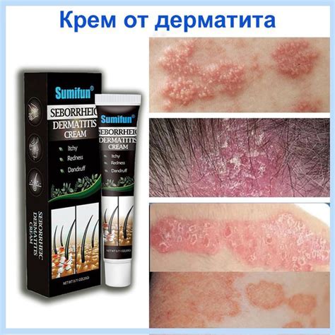 Использование оливкового средства для устранения покрытия себорейного дерматита