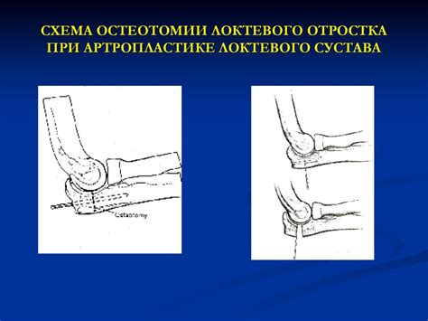Как избежать повторных повреждений локтевого сустава