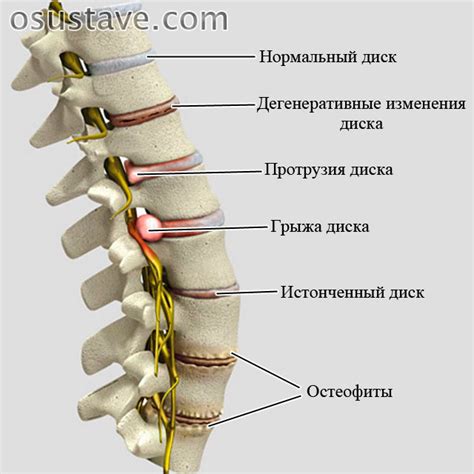 Лечение невральной компрессии пояснично-крестцового отдела