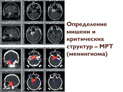 Менингиома: определение и основная информация