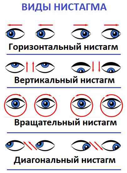 Методы диагностики нистагма у новорожденных