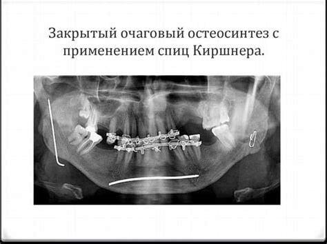 Методы для исправления повреждений и выпрямления изменений внешнего обтекателя