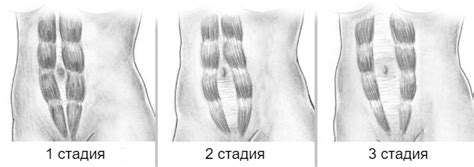 Мифы и реальные последствия тренировок мышц живота с установленной интраутеринной спиралью