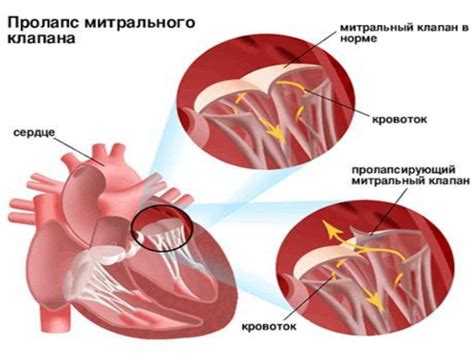 Определение нейтрального клапана сердца