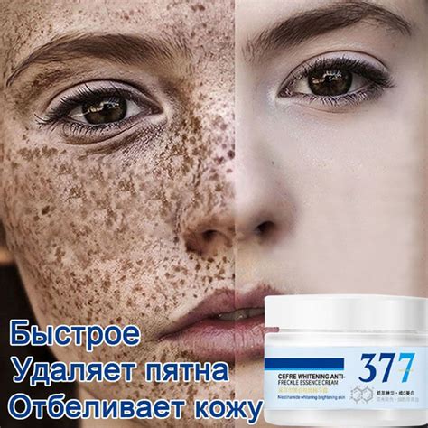 Осветление пигментных пятен: найдите свое зелье молодости