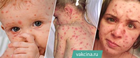Осложнения при прохождении заболевания ветрянкой у взрослых: ключевые моменты для внимательности