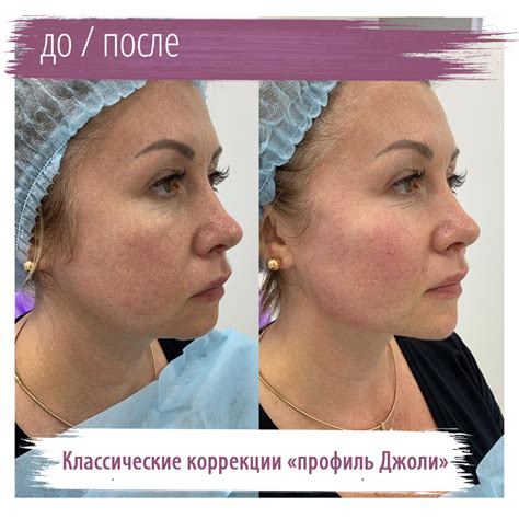 Основные принципы заботы о коже после процедуры моделирования лица