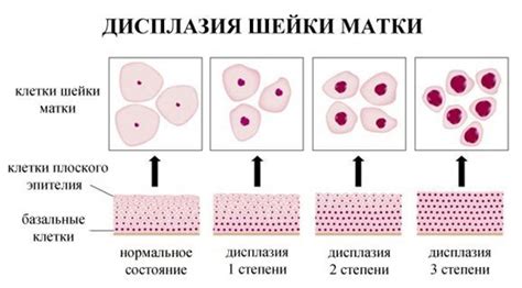 Основные симптомы низкой степени плоскоклеточного интраэпителиального поражения (LSIL)