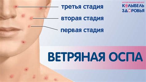 Особые подходы к диагностике ветрянки у взрослых: как избежать ошибок