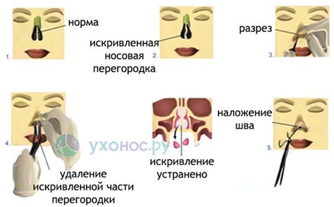 Подготовка организма к медицинской процедуре удаления перегородки в носу