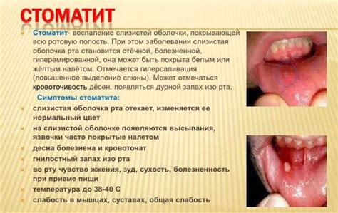Понятие и проявление стоматита