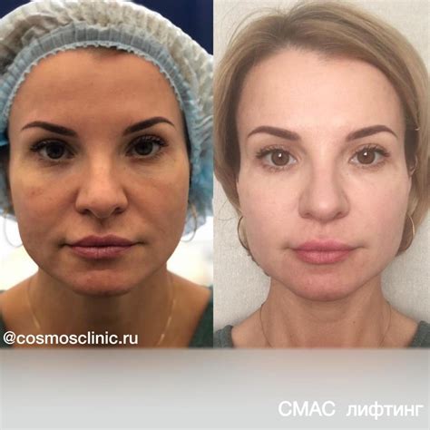 Постоянный результат и долгосрочное действие после процедуры