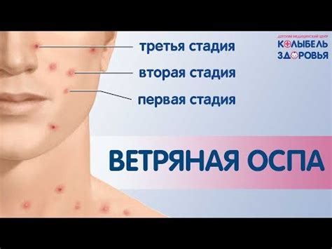 Почему ветрянка вызывает тревогу в обществе