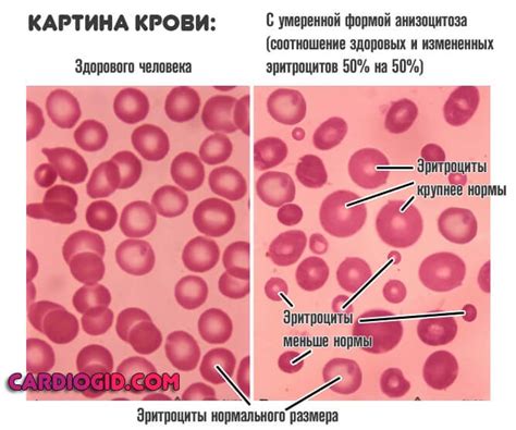 Причины анизоцитоза