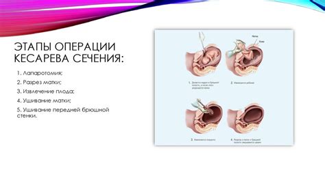 Причины осуществления кесарева сечения при многоводии
