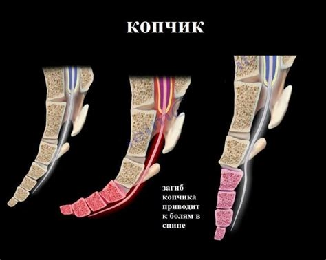Причины повреждения копчика во время родов: факторы риска и возможные последствия