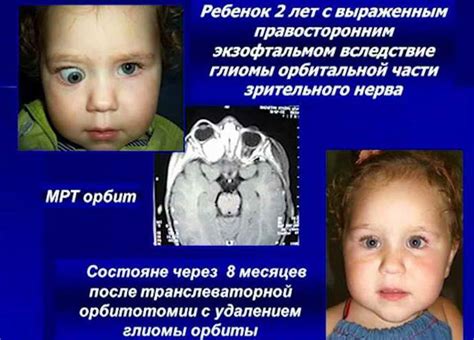 Причины развития нейробластомы у детей
