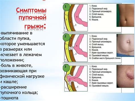 Причины расширения брюшной полости при грыже в области пупка