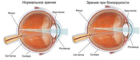 Проблемы, связанные с высокой степенью близорукости