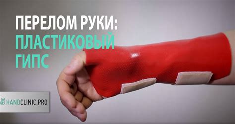 Процесс накладывания гипса на лучевую кость: суть процедуры