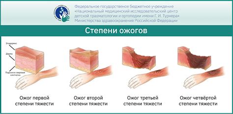 Риск ожогов и другие негативные последствия при длительных сеансах в солярии