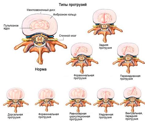 Роль генетики в здоровье хребетного диска