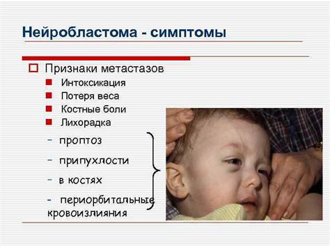 Симптомы и признаки нейробластомы у детей