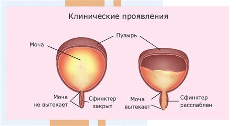 Симптомы нейрогенного мочевого пузыря у женщин