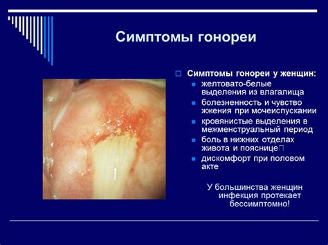 Симптомы нейссерии гонореи у женщин