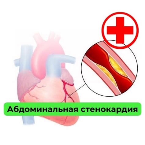 Стенокардия: корни и проявления