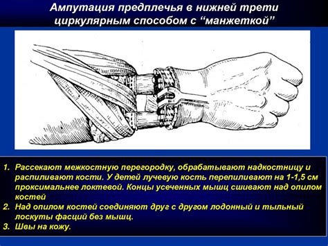 Строгая практика ампутации конечностей: исторический обзор и современные примеры