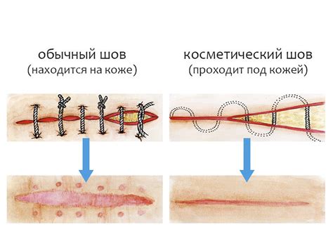 Четвёртый шаг: процесс заживления и восстановление после операции