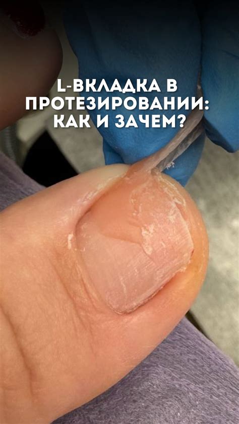  Мифы и факты о процедуре облегчения дискомфорта при вросшем ногте 